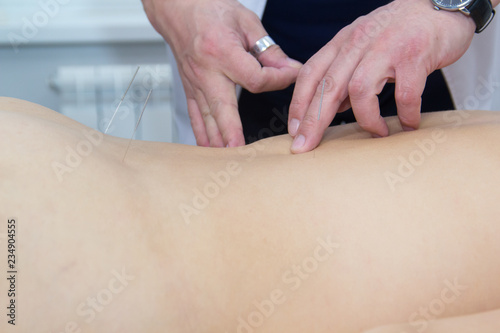 Young woman taking acupuncture treatment. Inserting needles. Close up