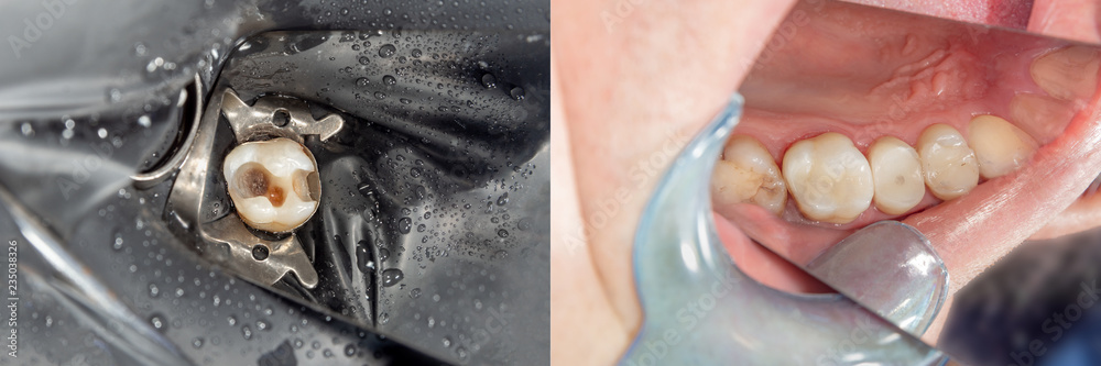 Naklejka premium Teeth during treatment close-up in a dental clinic. Dental photopolymer composite filler.