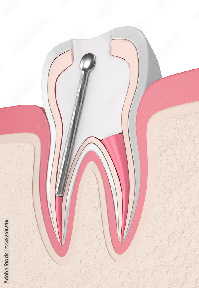 3d render of tooth with stainless steel dental post and filling 3d render of tooth with stainless steel dental post and filling