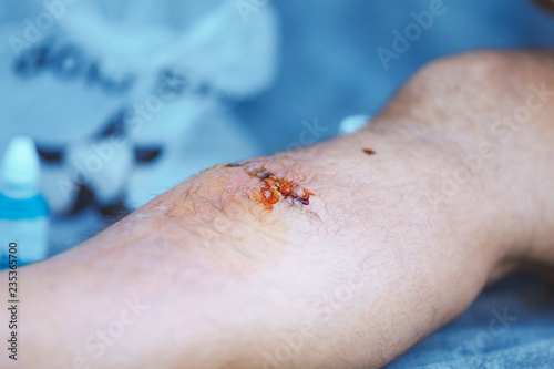 treatment of wound on man's leg with iodine