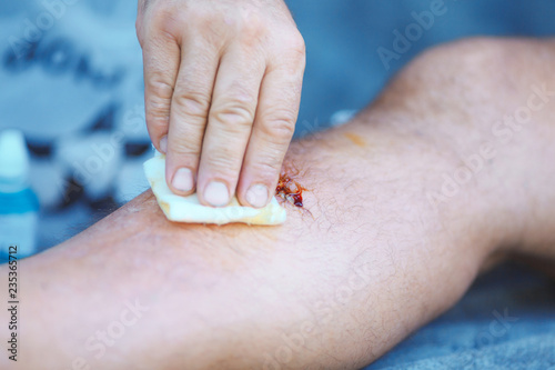 treatment of wound on man's leg with iodine