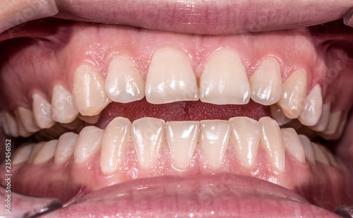Healthy human teeth with normal occlusion from frontal view