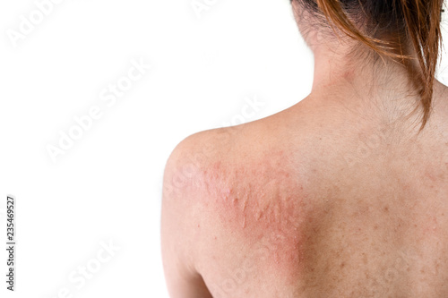 Back of young asian woman have itchy with allergy rash on white background, Selective focus, Health allergy skin care problem.