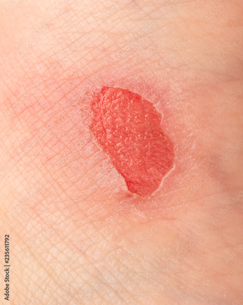 Fototapeta premium red leg wound