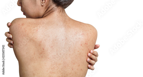 Young Asian woman have acne with red spots on the back isolate on white background, with clipping path, Healthy skin concept. photo