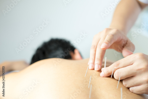 acupuncture treat concept