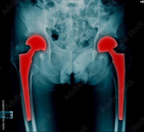 bilateral hip replacement x-ray imge photo