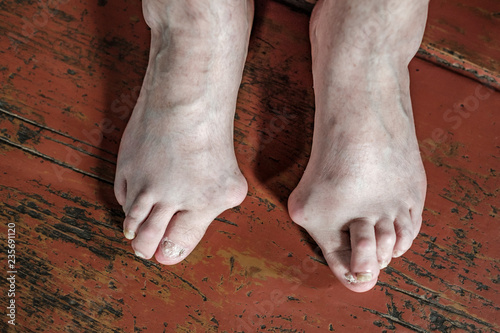 Foot which have bunion (hallux valgus) problem on  floor
