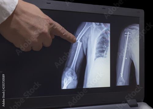 Fototapeta Xray of fracture of a hand and hand after operation