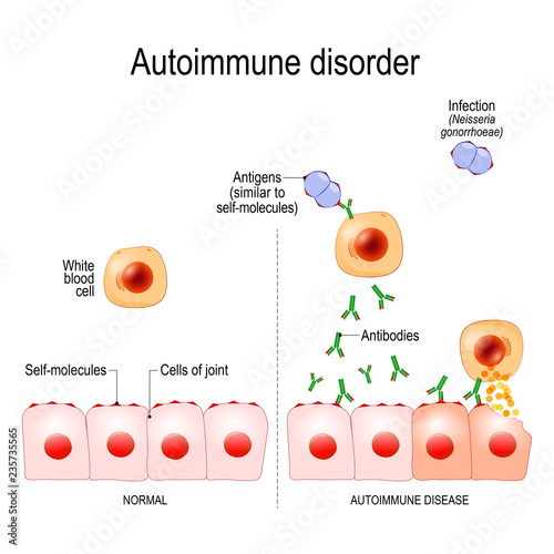 Autoimmune disorders photo