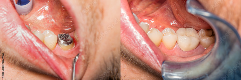 Fototapeta premium tooth crown on plaster model of human jaw. Macro close-up of the process of manufacturing an anatomical crown of a tooth. The concept of dental restoration of teeth