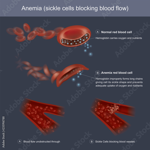 Hemoglobins improperly forms long chains giving cell its sickle shape and prevents adequate uptake of oxygen and nutrients