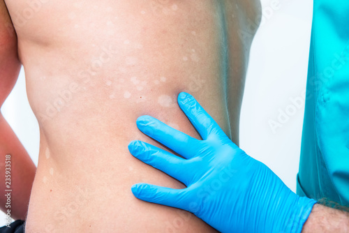 Close up doctor dermatologist hands in gloves examines skin depigmentation on mans back. Selective focus. copy space. © okrasiuk