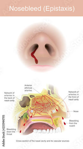 Bleeding from the sinuses is caused by the tear of the arteries within the nasal cavity.