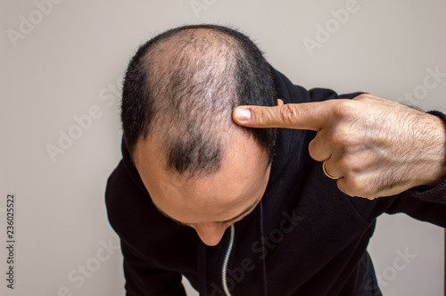 Young man showing his baldness photo