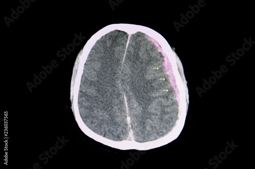 CT brain subarachnoid hemorrhage