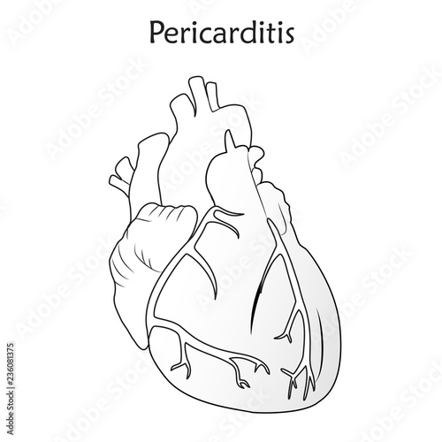 Pericarditis. Inflammation of the pericardium. Damaged heart muscle. Anatomy flat illustration. Outline image, white background.