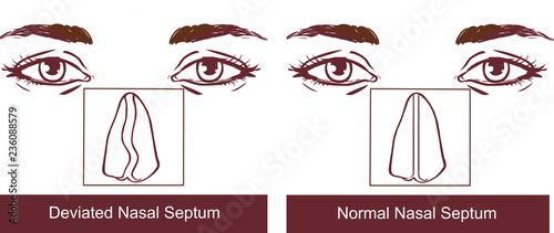 Nasal Septum Deviation Treatmen