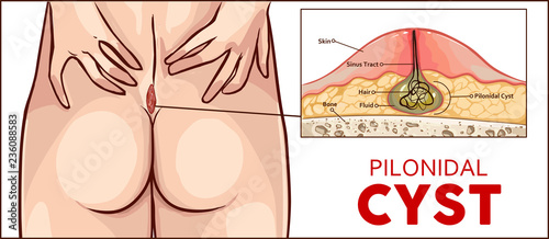  Vector illustration Pilonidal cyst formation
