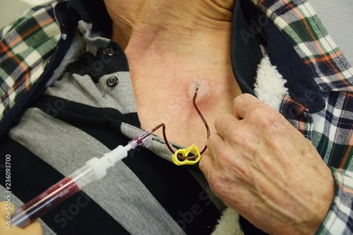 Blutabnahme vor einer Chemotherapie durch einen Port an der Brust eines alten Mannes