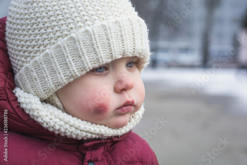 Sad and frightened little boy with bruise injury on face winter outside. abuse and bullying concept. Domestic Family violence and aggression.