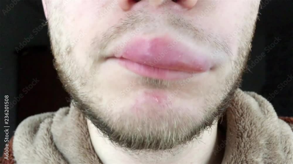 Wideo Stock: allergic reaction in a man on the lip. Angioedema. Quincke ...