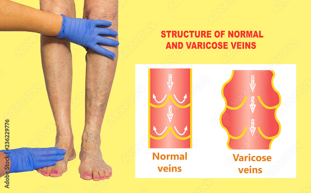 Varicose veins on a female senior legs. The structure of normal and