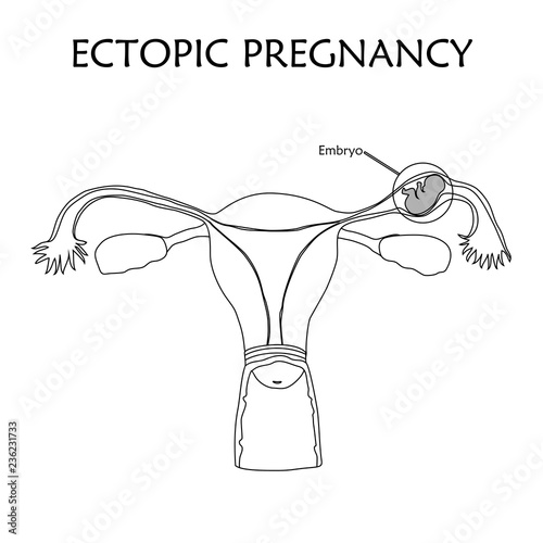 Ectopic pregnancy. Embrio, fetus in fallopian tube, uterus, womb. Anatomy thin line flat illustration. White background.