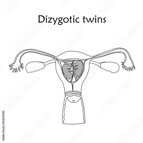 Multiple pregnancy. Dizygotic twins, embryo, fetus in uterus, placenta, umbilical cord. Vector flat medical illustration. Thin line image, white background.