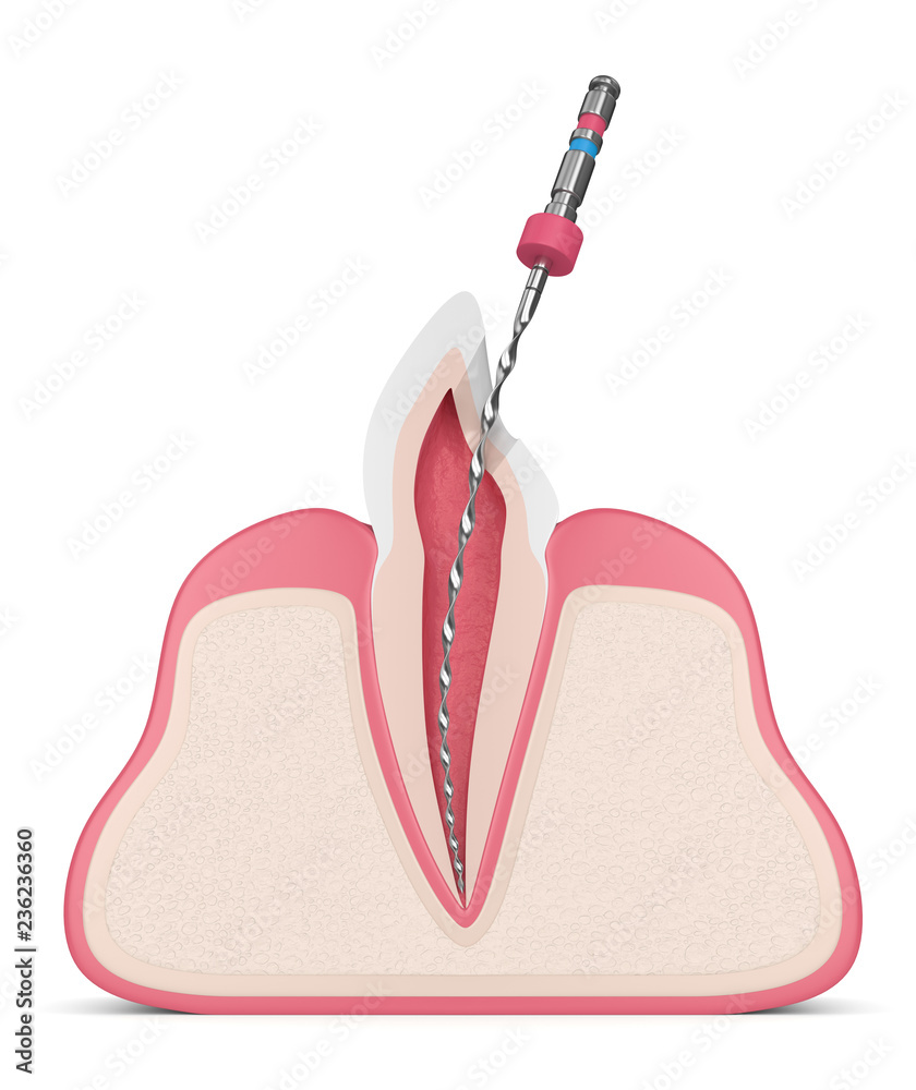 3d render of tooth with endodontic file in gums 3d render of tooth with endodontic file in gums