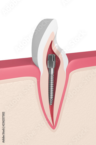 3d render of incisor tooth with dental metal post