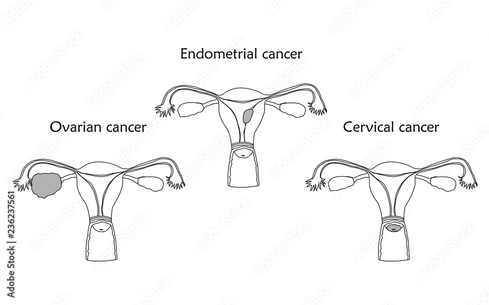 Ovarian, endometrial and cervical cancer. Human realistic uterus. Anatomy flat illustration