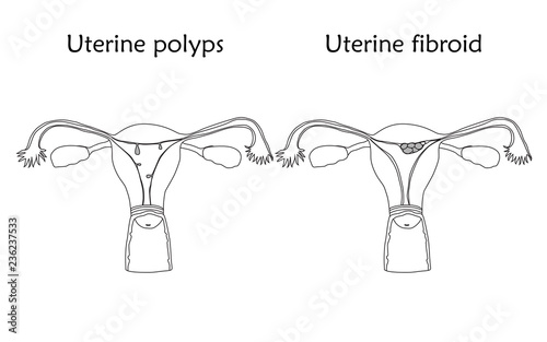 Uterine polyps and uterine fibroid. Human realistic uterus. Anatomy flat illustration. Thin line image, white background. Gynecological diseases.