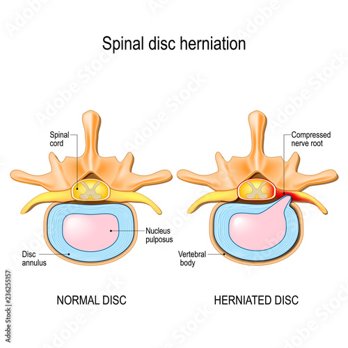Normal disc and spinal disc herniation in cervical vertebrae. photo