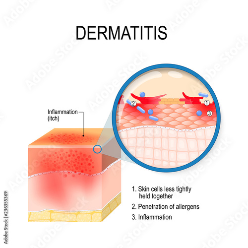 Atopic dermatitis (atopic eczema)