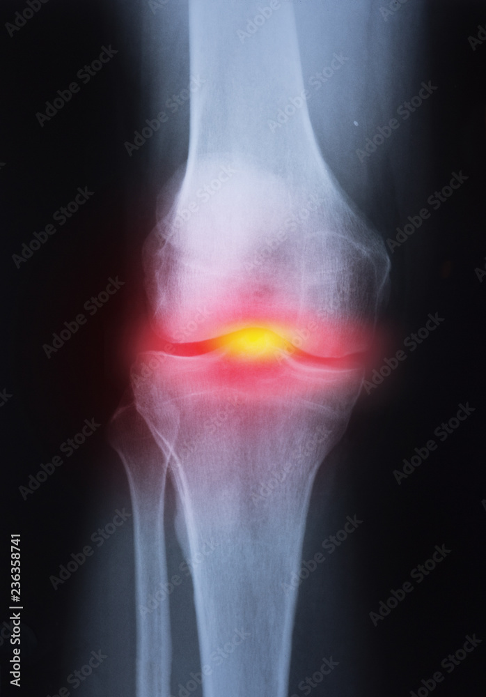 Medical xray knee joint image with arthritis ( Gout , Rheumatoid arthritis , Septic arthritis