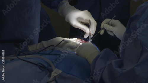 Close up, pan shot, Africa Mercy. Surgeon, assistant, lying patient,  in light blue  protective wear, white hand gloves, bright light focused on patient's face, holding and clamping, tube,  instrume photo