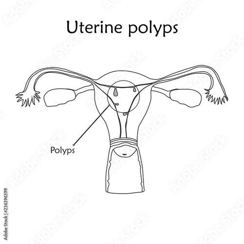 Uterine polyps. Human realistic uterus. Anatomy flat illustration with specification. Thin line image, white background. Gynecological diseases.