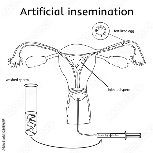 Artificial insemination. The fertilized egg, washed, injected sperm, uterus, womb, syringe. Anatomy flat thin line illustration. White background.