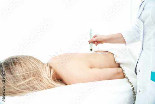 Woman being treated with acupuncture and moxibustion treatments