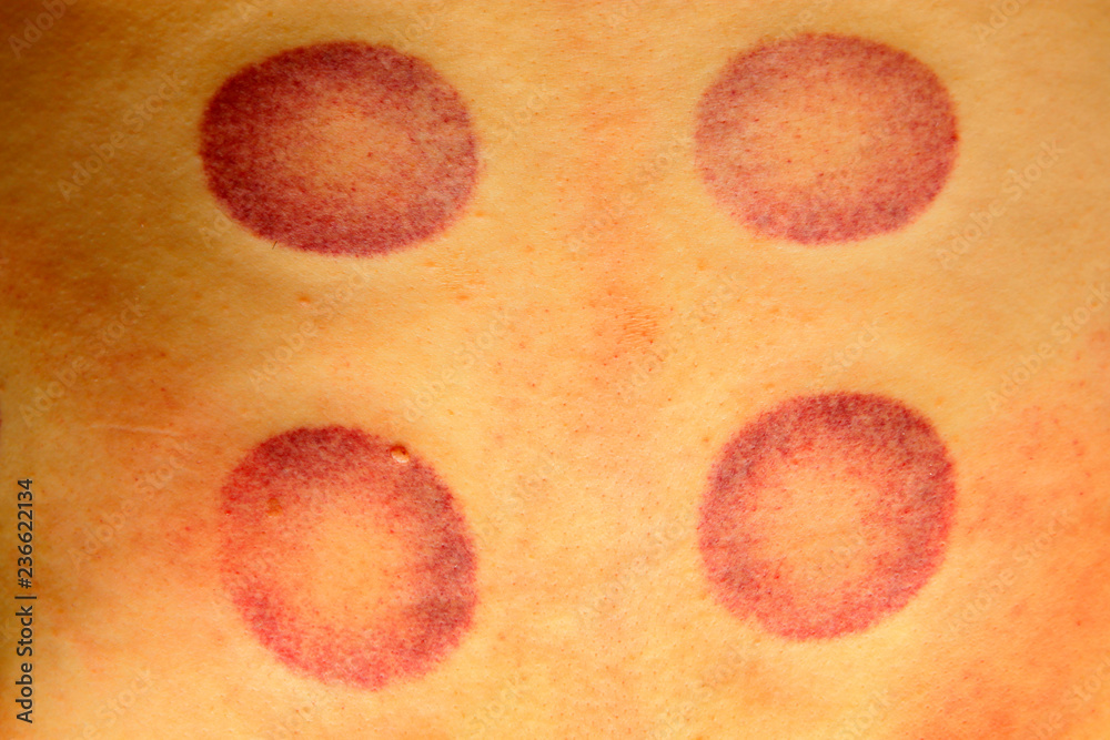 cupping therapy, Chinese traditional medical method marks on the skin