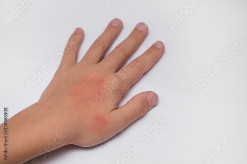 Red spots on child hands skin covered with moisture cream. The cause is winter cold and wind conditions. Light grey background.