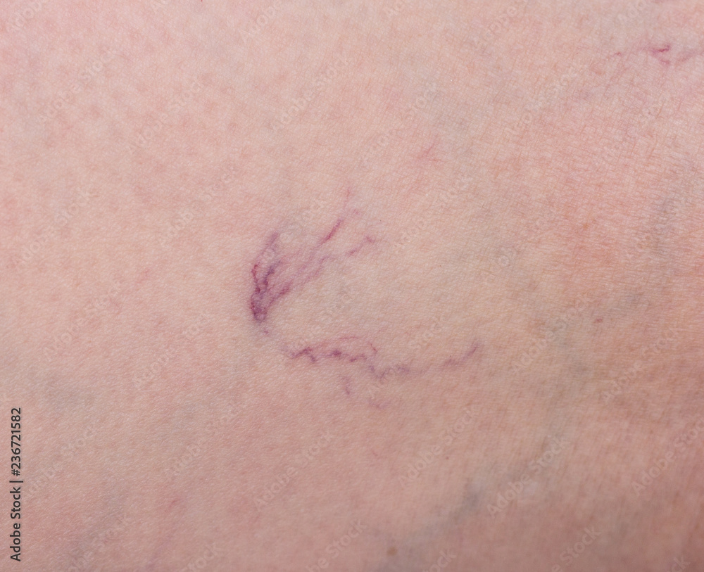 Footprint on the skin from vascular dilatation of veins, vascular pattern on human skin, close-up, phlebeurysm, capillaries, medical Footprint on the skin from vascular dilatation of veins, vascular pattern on human skin, close-up, phlebeurysm, capillaries, medical