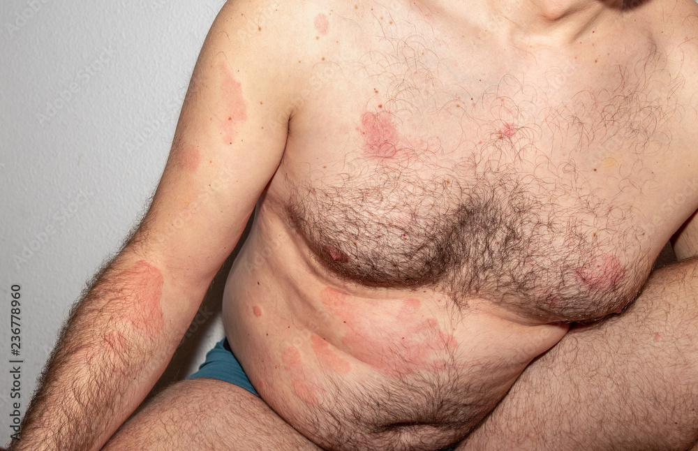 Obraz premium Histamine. Allergy. Reaction. Intolerance. Health