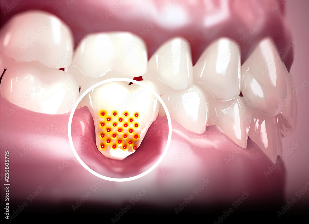 Bocca, denti, gengive. Denti sensibili, ritiro della gengiva
