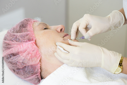 Close-up of procedure for face lifting PDO Suture operation, face lifting surgery. innovative technique of New thread lift, NovaThreads and Silhouette InstaLift photo