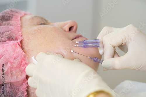 Tablou pe pânză Close-up of procedure for face lifting PDO Suture operation, face lifting surgery