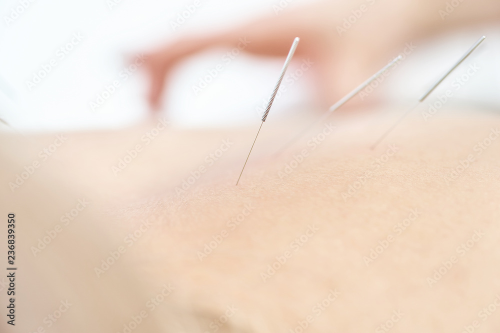 Alternative medicine. Close-up of female back with steel needles during procedure of acupuncture therapy.
