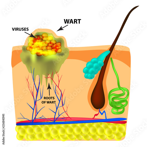 The structure of the wart. The structure of the skin. Infographics. Vector illustration on isolated background.