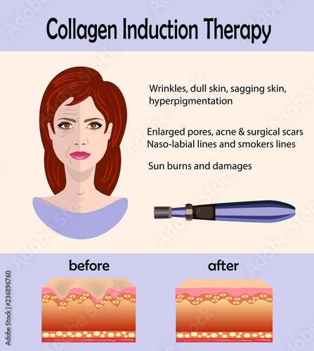 Before after effect, Microneedle stamping device, Collagen induction therapy photo
